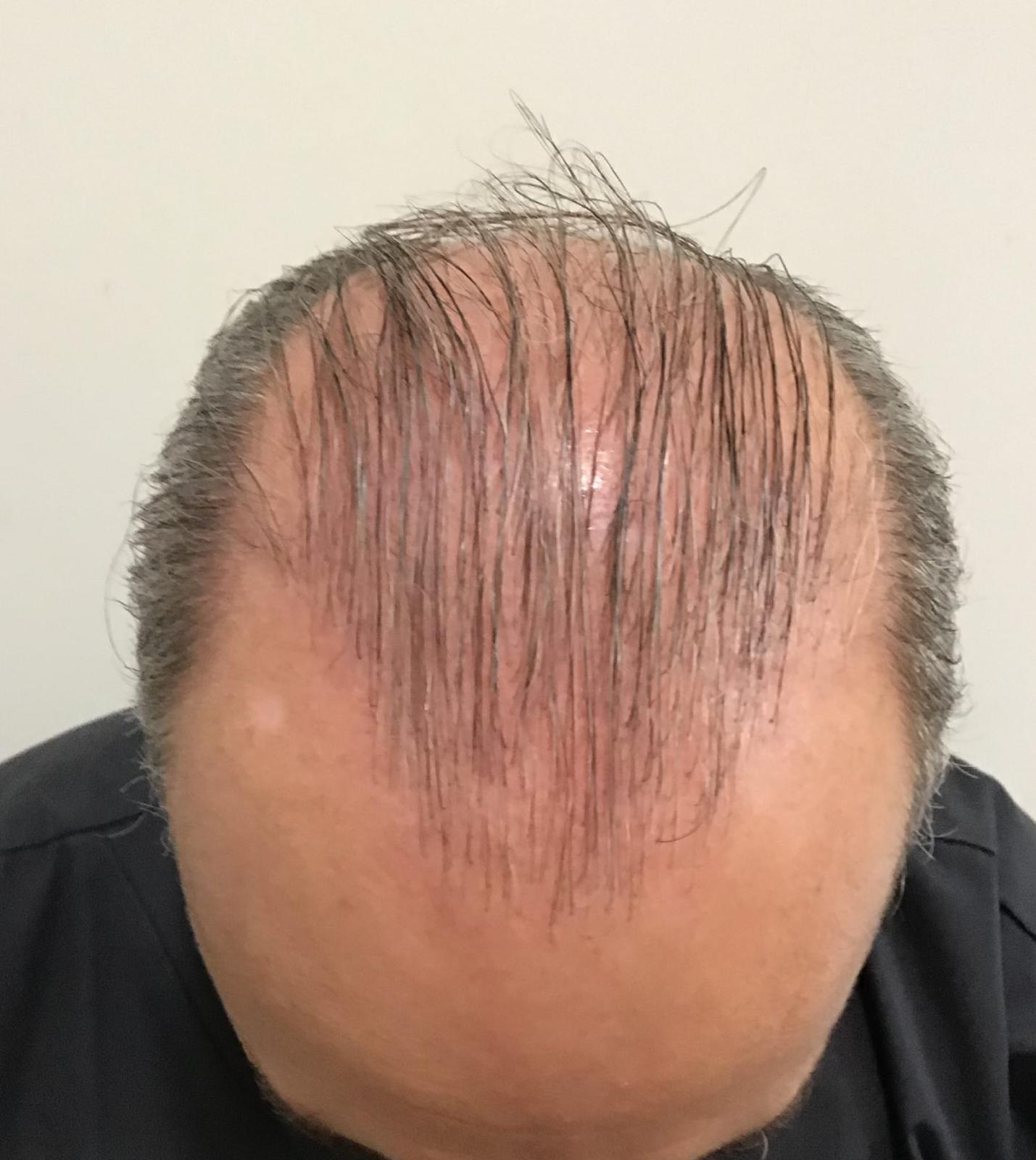 Caso 1: antes del trasplante capilar