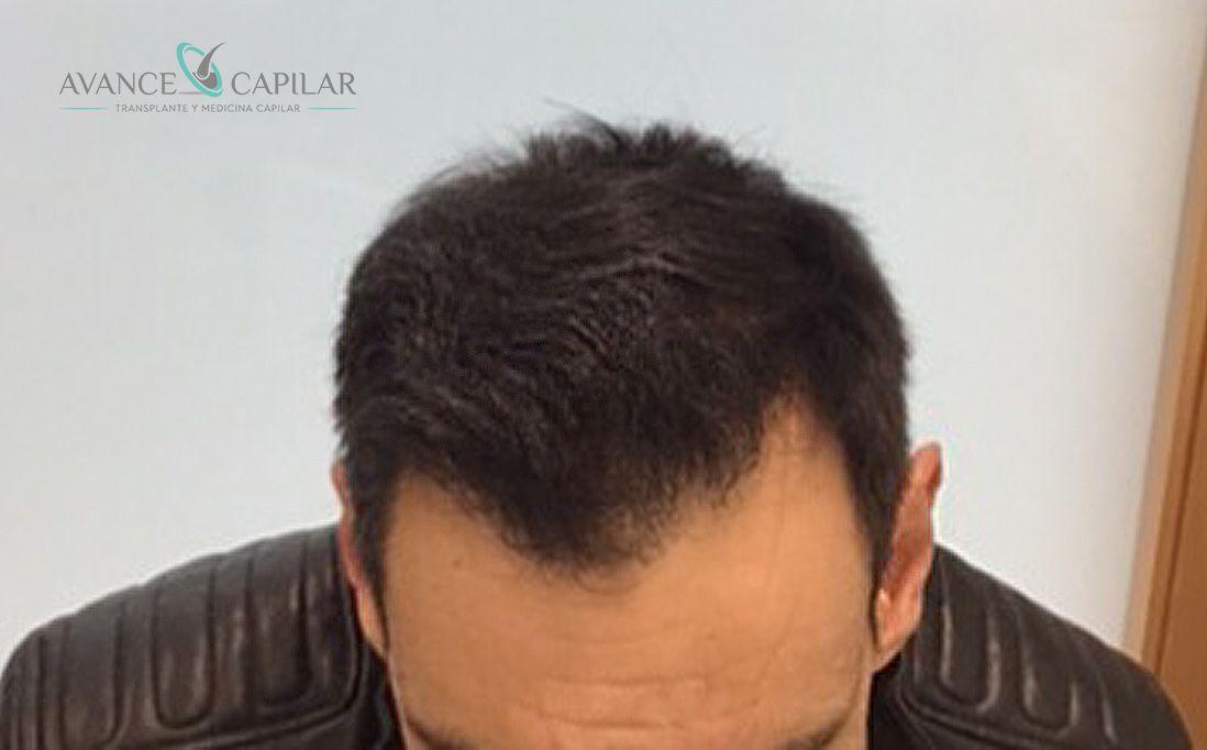 Caso 2: después del trasplante capilar